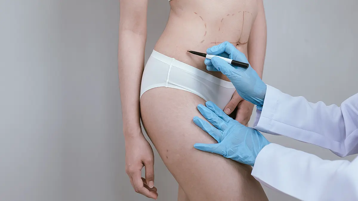 Пересадка трупного жира для коррекции фигуры: опасность, альтернативы