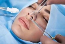 Тигран Алексанян - мифы и реальность ринопластики tigran aleksanyan mify i realnost rinoplastiki-obzone-su-0