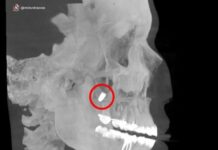 Центр «Бонум» в Екатеринбурге вернул здоровье пациентке с мигрировавшим имплантом czentr bonum v ekaterinburge vernul zdorove paczientke s migrirovavshim implantom-uralnovosti-ru-174659889500-0