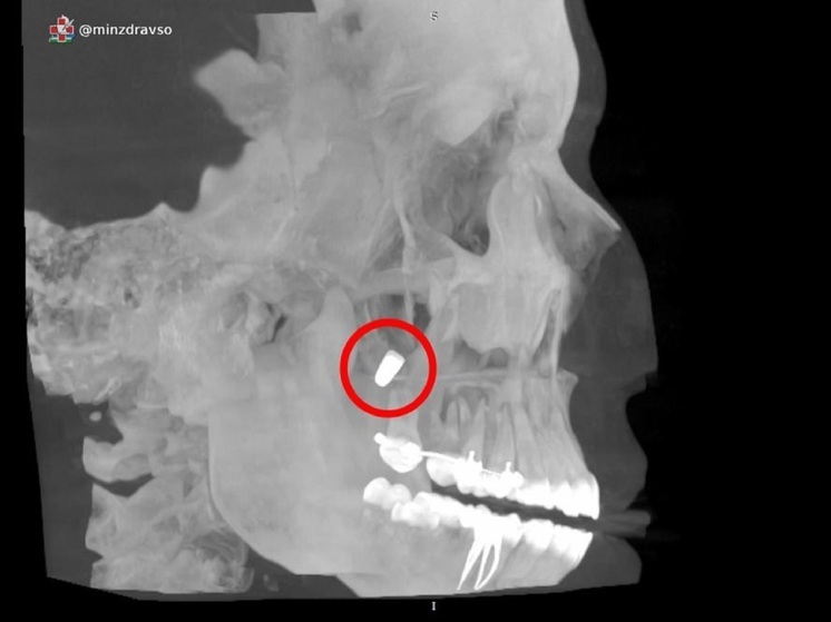 Свердловские врачи помогли пациентке, у которой зубной имплант дошел до носа