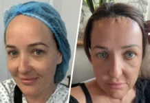 Хлоя Уокер рассказывает, как уменьшение лба дало ей уверенность и свободу hloya uoker rasskazyvaet kak umenshenie lba dalo ej uverennost i svobodu-uralnovosti-ru-0