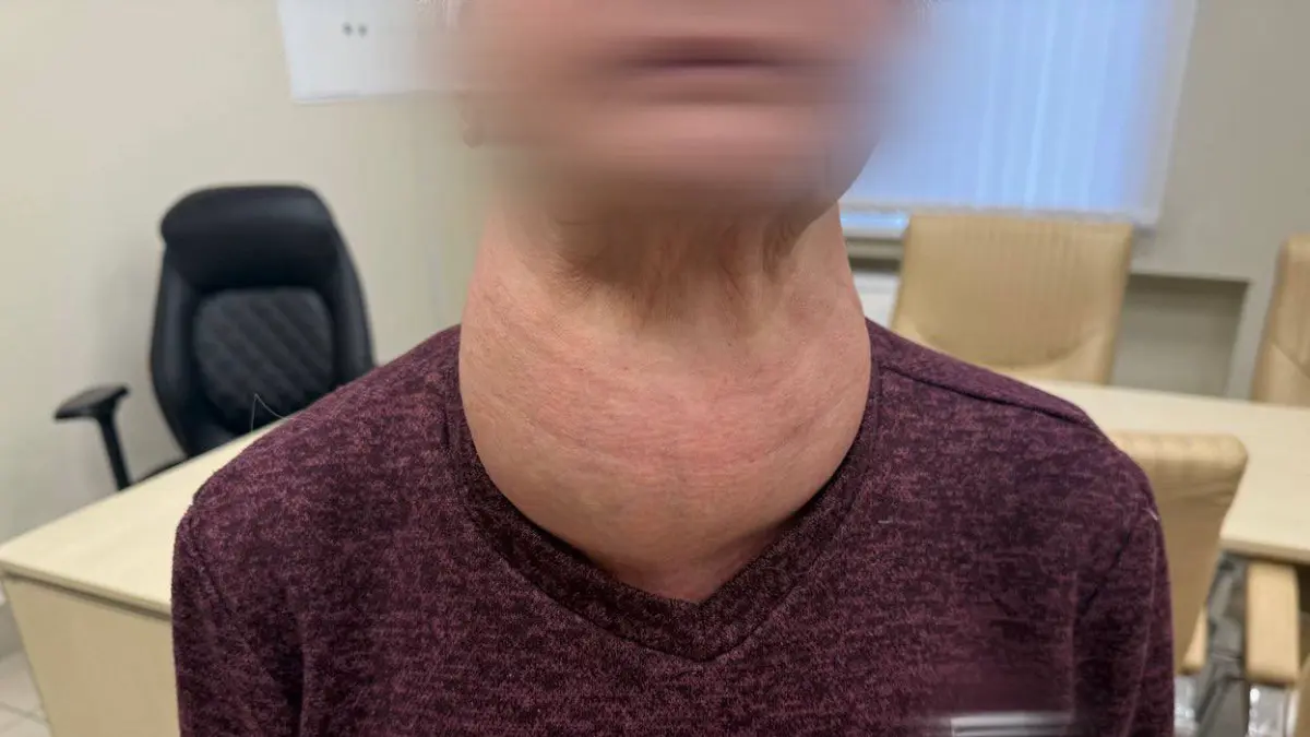 Хирурги РКБ Татарстана удалили у женщины щитовидную железу размером с голову