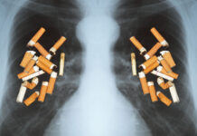 Lung cancer