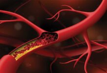 Artery blocked by cholesterol. Vector illustration
