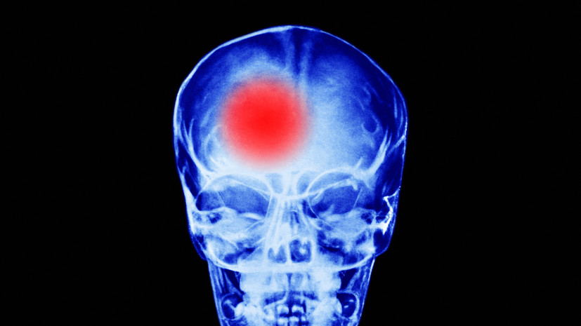 Врач Тен: физическая активность поможет восстановиться после инсульта