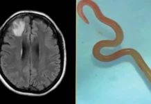 Австралийка заразилась уникальным паразитом Ophidascaris robertsi avstralijka zarazilas unikalnym parazitom -politgolos-ru-0