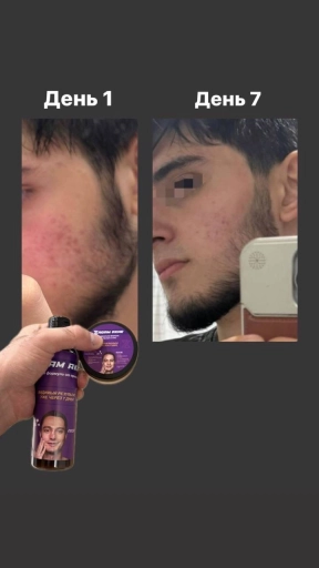 ZAGAM AKNE – Эликсир от прыщей и акне