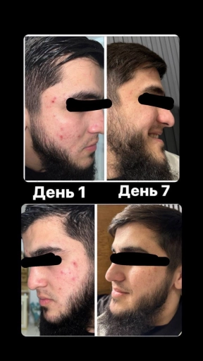 ZAGAM AKNE – Эликсир от прыщей и акне