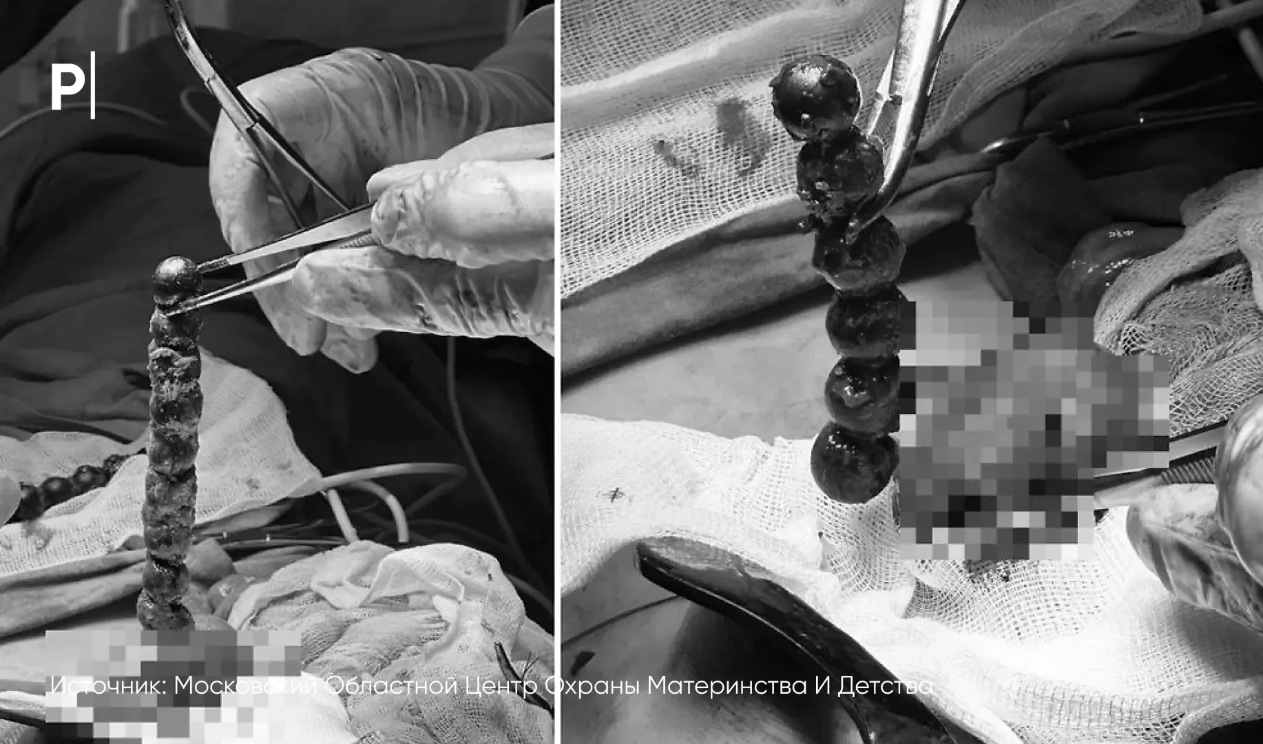 👨‍⚕️Врачи извлекли из ребенка килограмм магнитов.  На рентгеновском снимке в брюшной полости ребенка