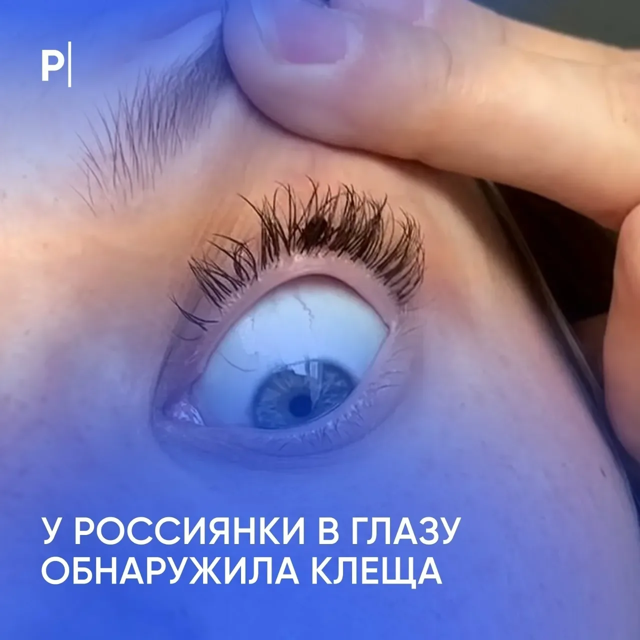 👁 В Оренбургской области врачи достали клеща прямо из глаза пациентки.    26-летняя Анастасия обнару