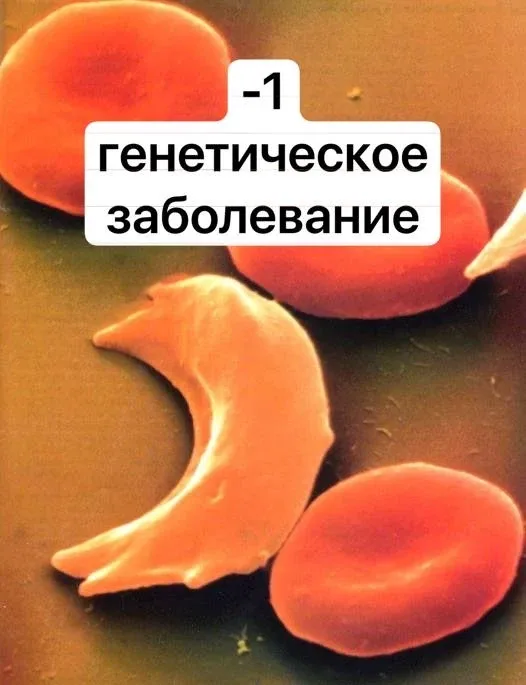 Себастьен Бозиль стал первым человеком, излечившимся от серповидноклеточной анемии (эритроциты при э
