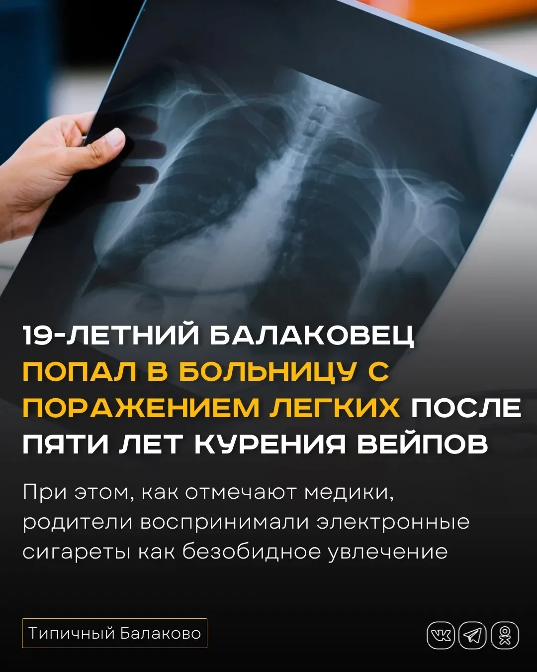 19-летний балаковец попал в больницу с поражением легких после пяти лет курения вейпов  В Балакове 1
