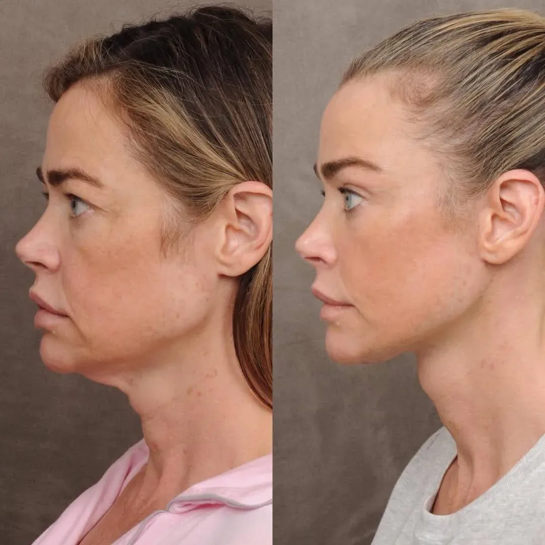 У меня нет цели вам навязывать подтяжку лица. Просто захотелось поделиться удачной работой на пример