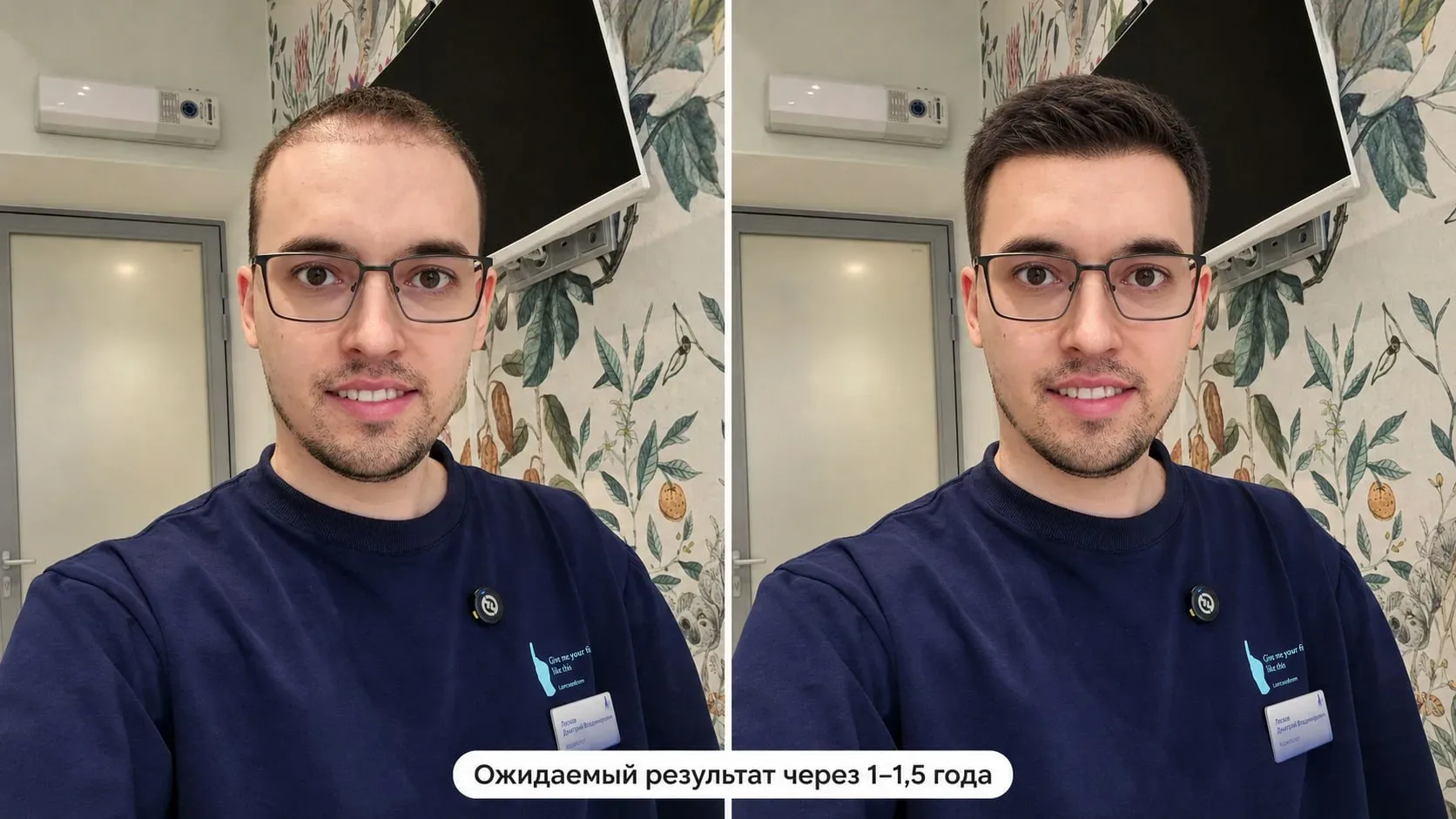 Финастерид и дутастерид не связаны с риском сердечно-сосудистых заболеваний  Мои дорогие лысеющие му