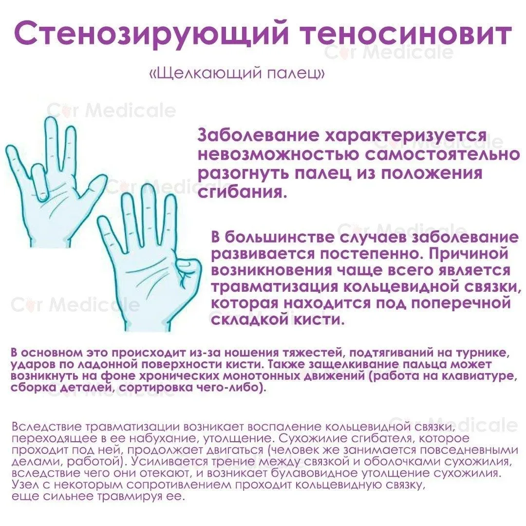 Стенозирующий теносиновит