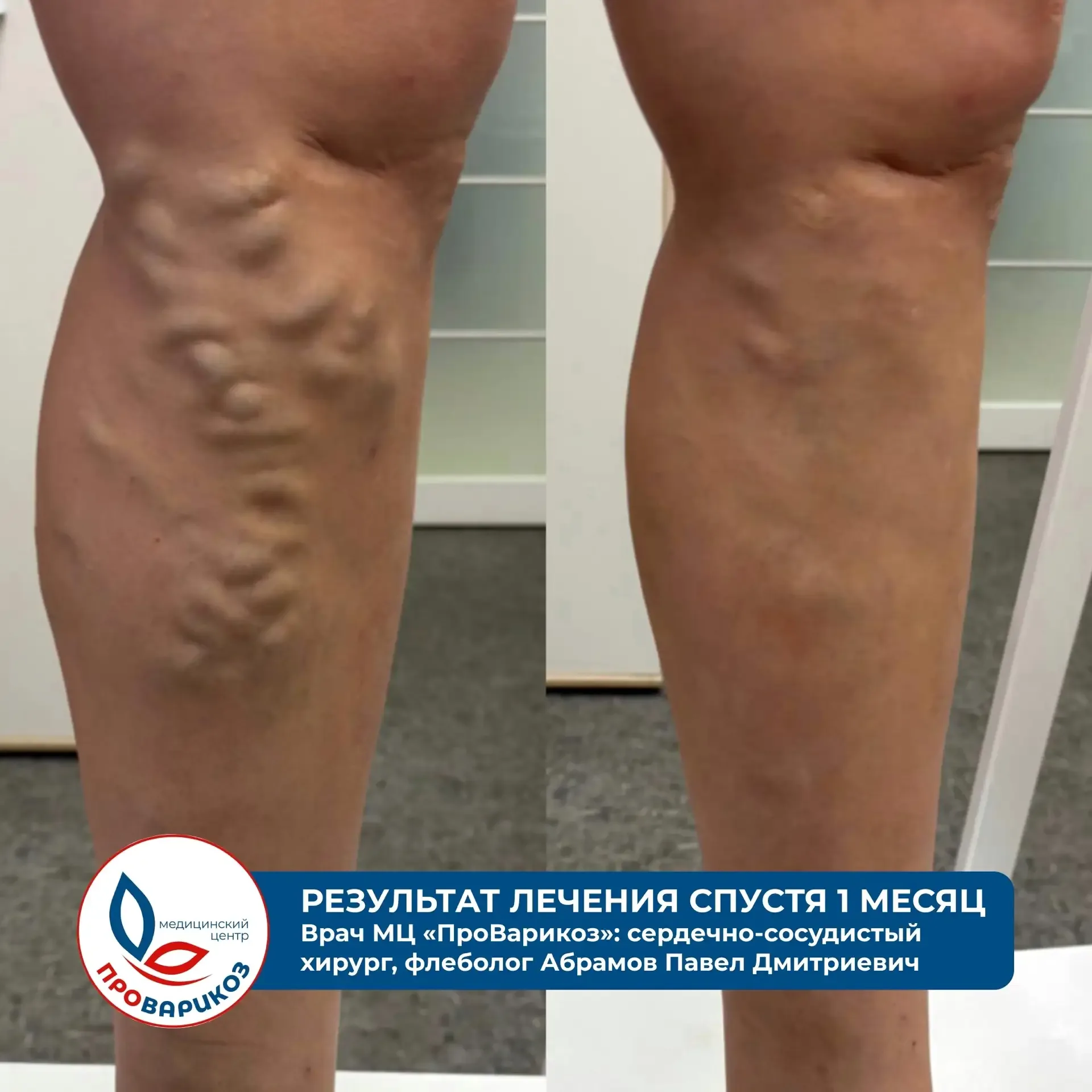 Флеболог из Волгограда — в Михайловке всего на 1 день    ❗Только 16 мая в Михайловке ведёт приём фле