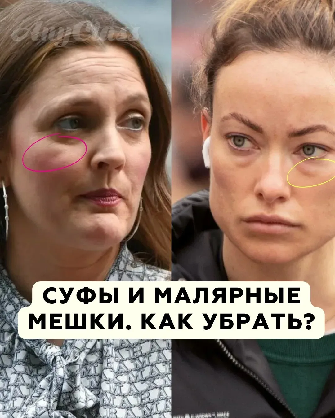 Суфами принято называть припухлости на скулах, в верхней их точке. Не путайте суфы (или скуловые гры