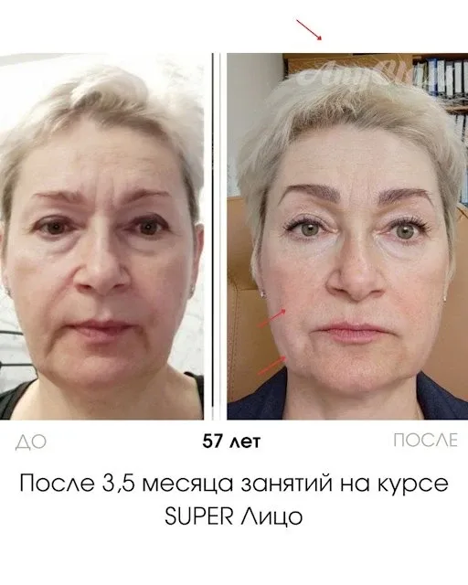 Суфами принято называть припухлости на скулах, в верхней их точке. Не путайте суфы (или скуловые гры