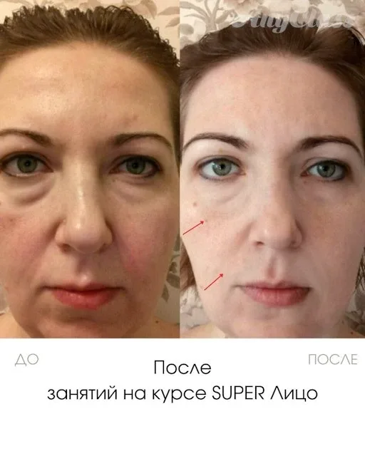 Суфами принято называть припухлости на скулах, в верхней их точке. Не путайте суфы (или скуловые гры