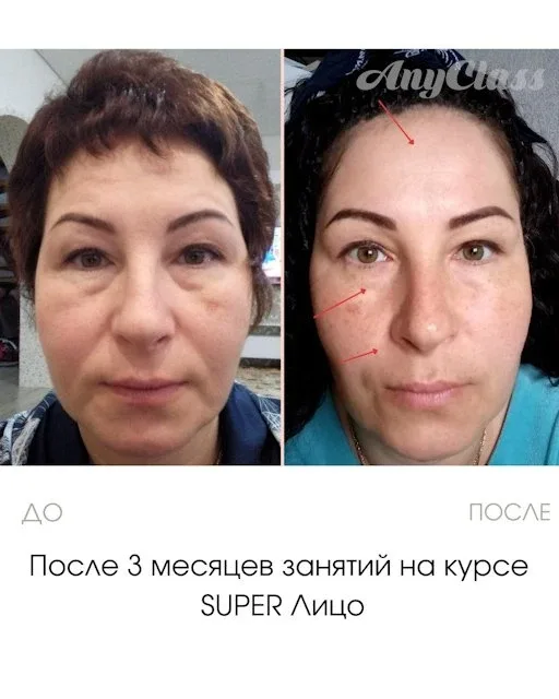 Суфами принято называть припухлости на скулах, в верхней их точке. Не путайте суфы (или скуловые гры