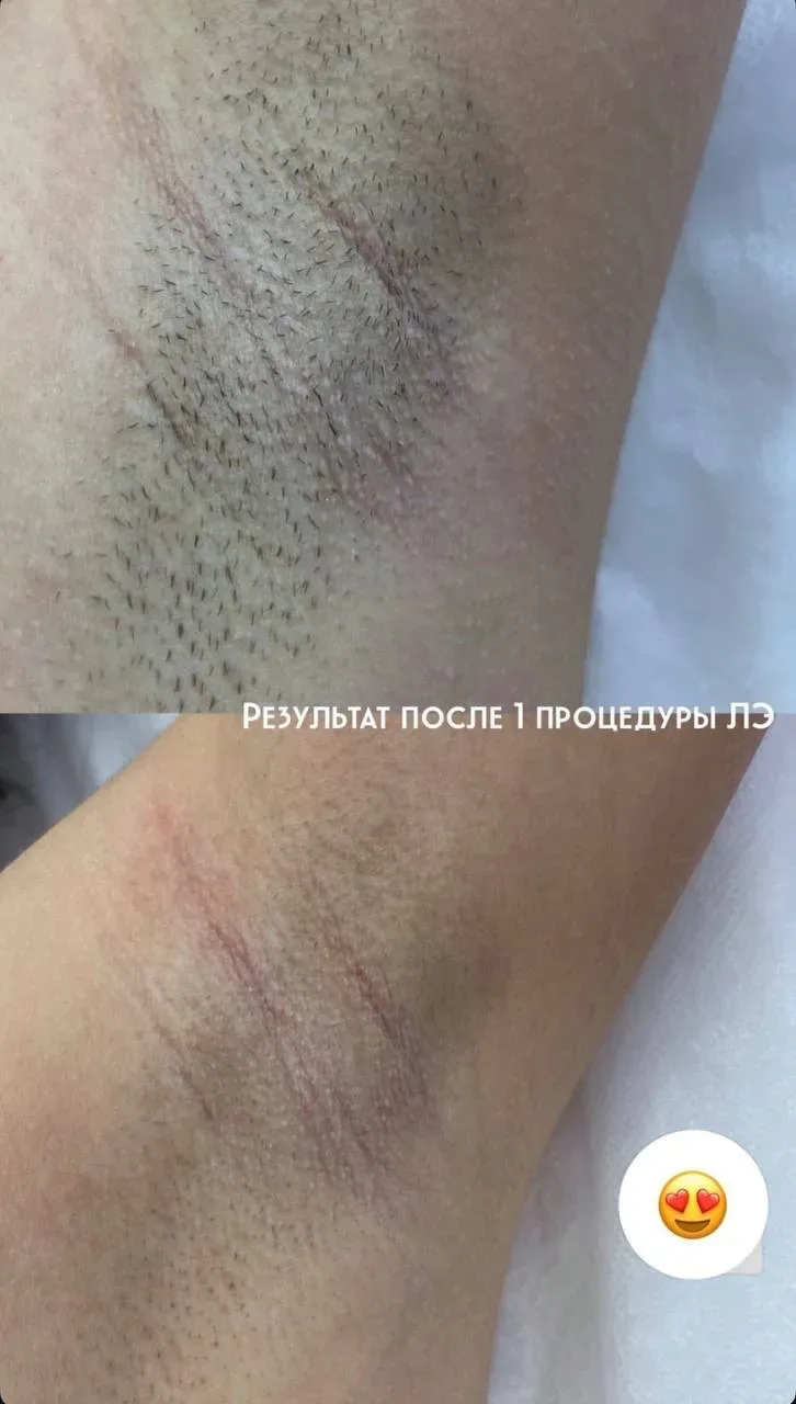 Ваша гладкая кожа мечты в        ЖК ЛАЗУРНЫЙ  Сеть ЛАЗЕРНОЙ ЭПИЛЯЦИИ            ЛазерАни  Устали от 