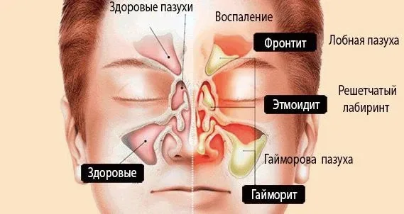 Синусит  Проблема довольно частая у многих, поэтому хочу поделиться одним рецептом.  Конечно, лучше 