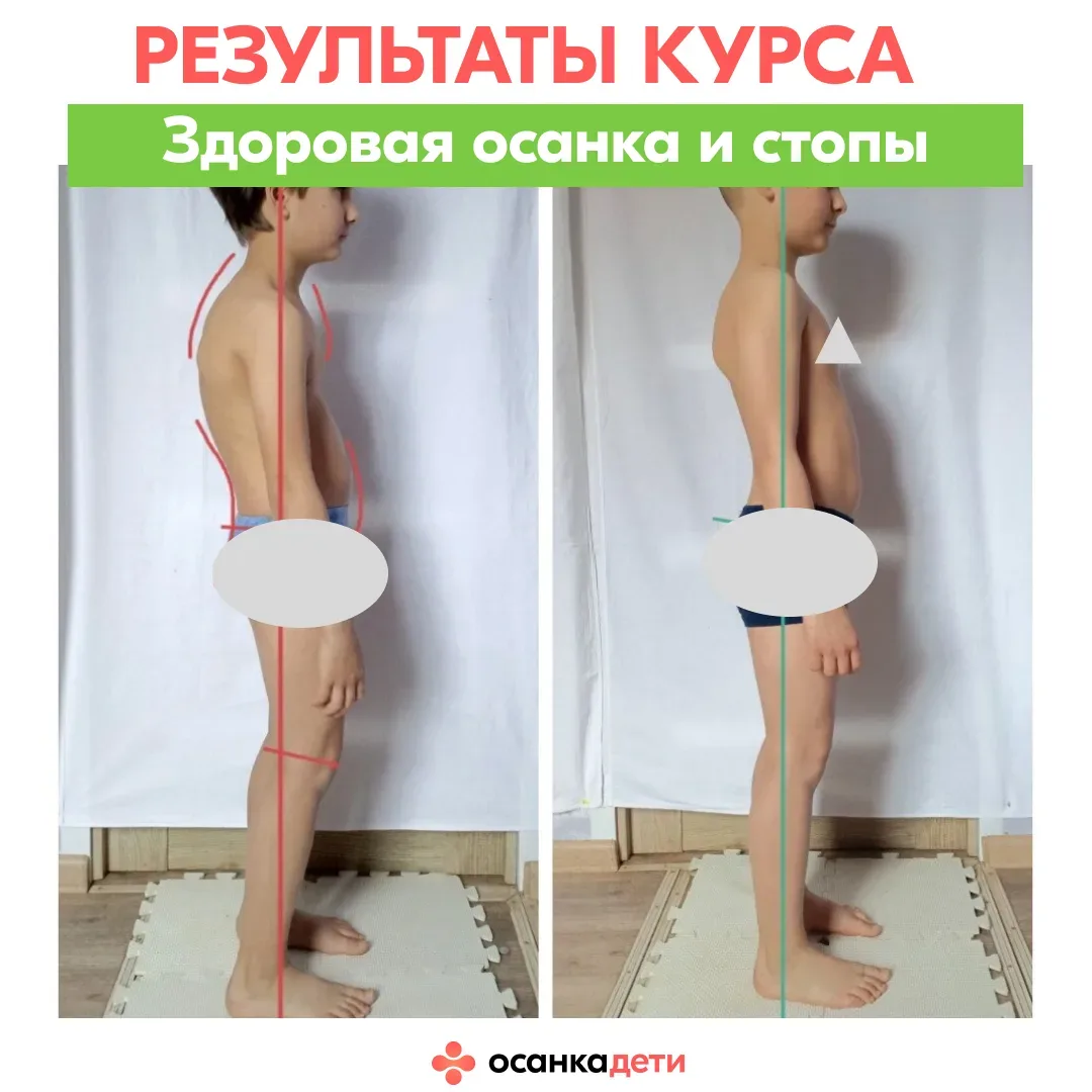 РЕЗУЛЬТАТЫ КУРСА  Его «до» — это стельки, «рукопашка» и ….  сутулость. После — смотрите в карусели р
