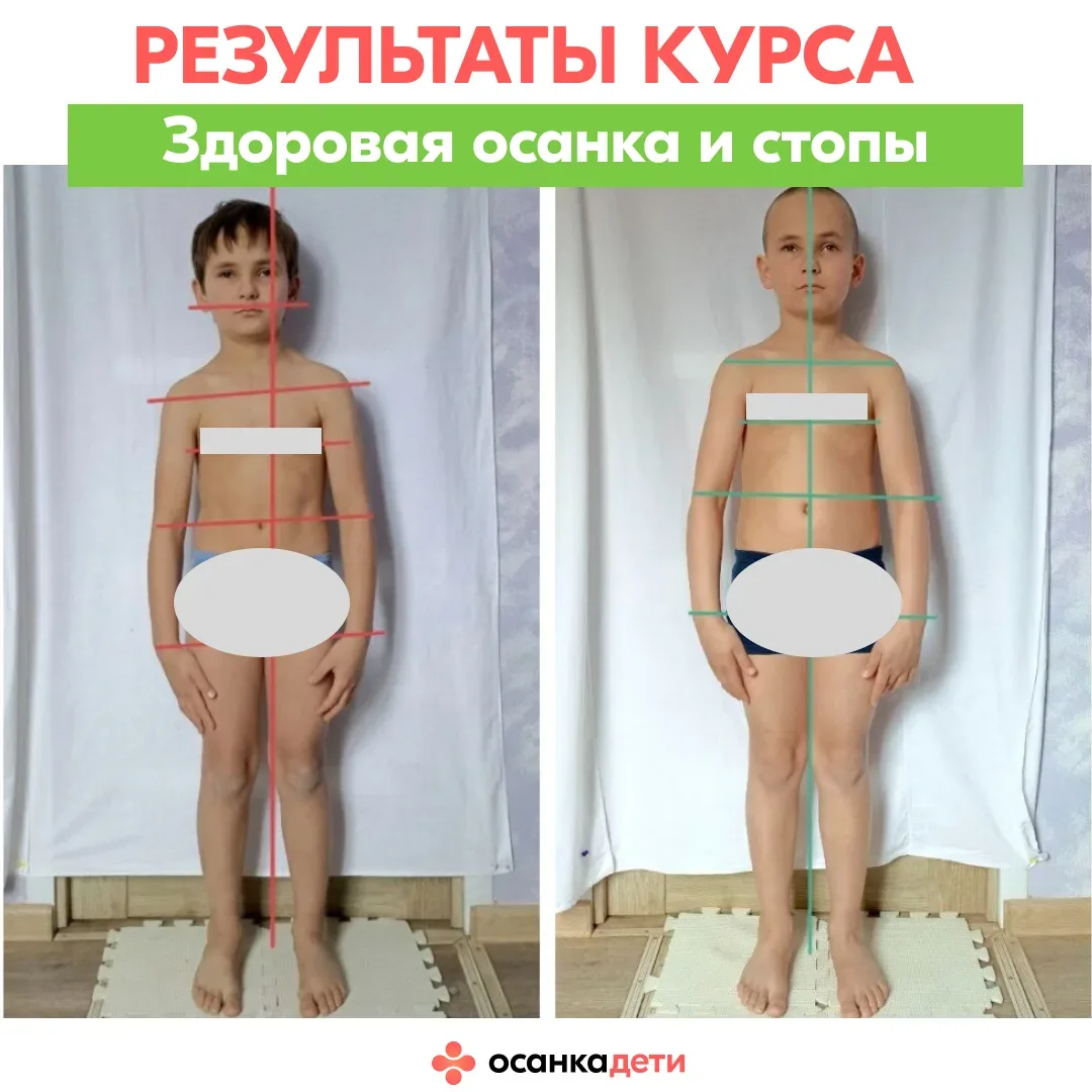 РЕЗУЛЬТАТЫ КУРСА  Его «до» — это стельки, «рукопашка» и ….  сутулость. После — смотрите в карусели р