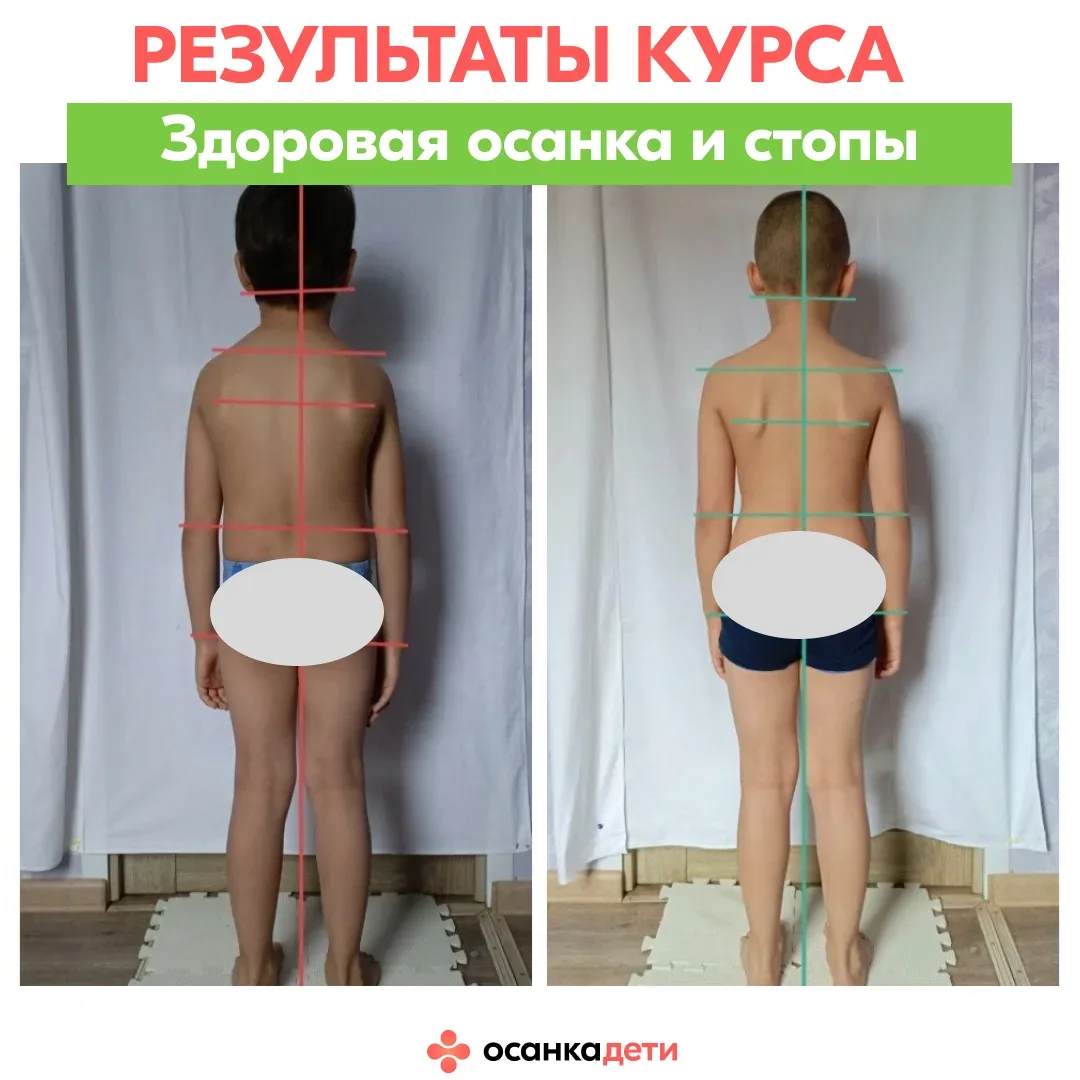 РЕЗУЛЬТАТЫ КУРСА  Его «до» — это стельки, «рукопашка» и ….  сутулость. После — смотрите в карусели р