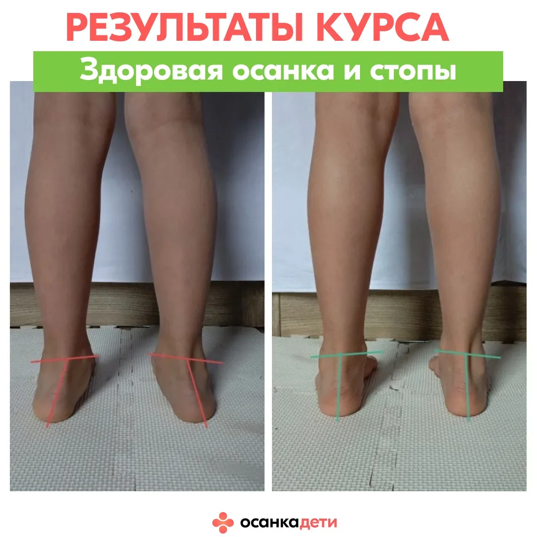 РЕЗУЛЬТАТЫ КУРСА  Его «до» — это стельки, «рукопашка» и ….  сутулость. После — смотрите в карусели р