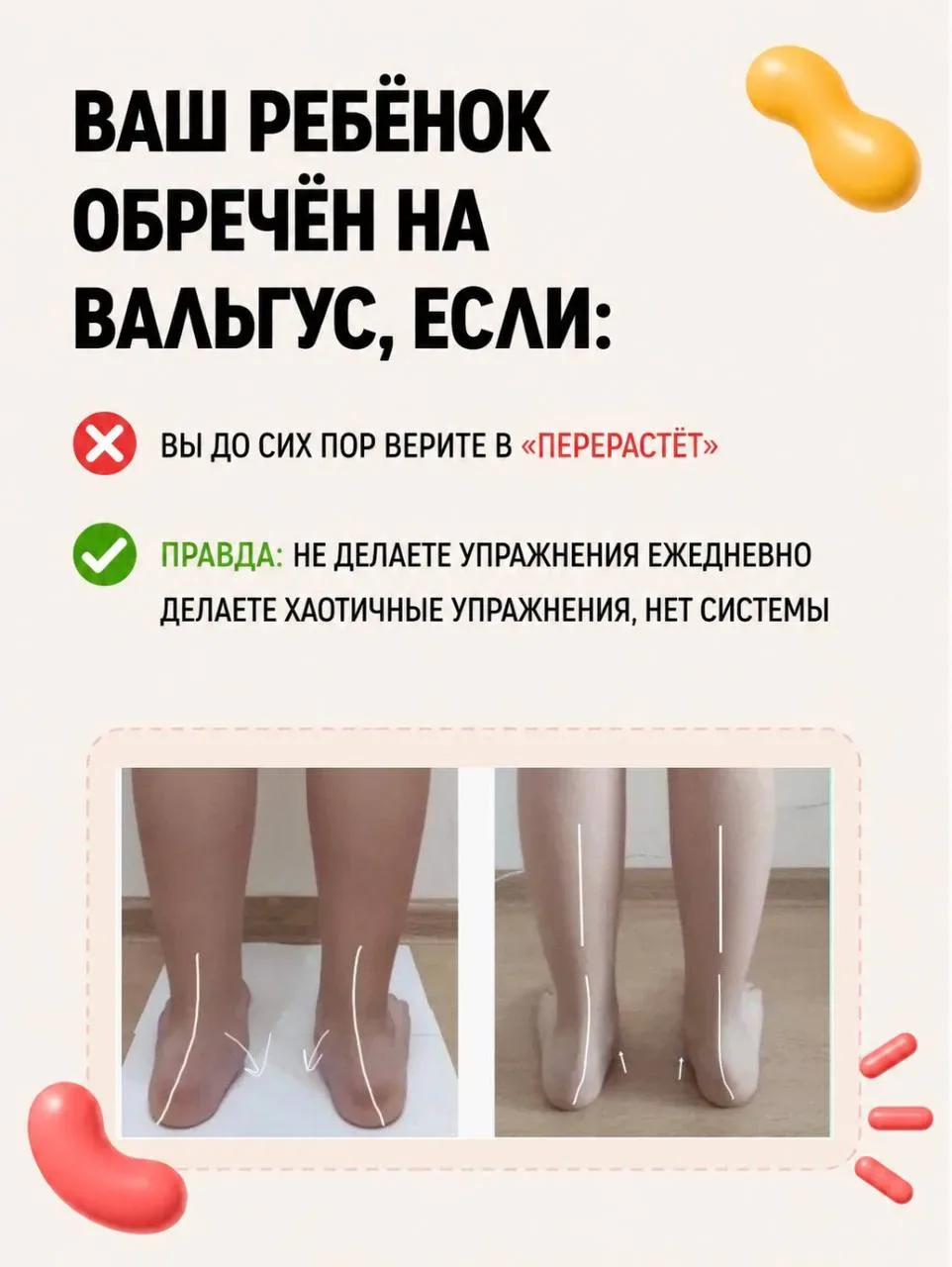 Вальгус исправляется. Но только если вы не совершаете эти ошибки.  Большинство родителей годами ждут