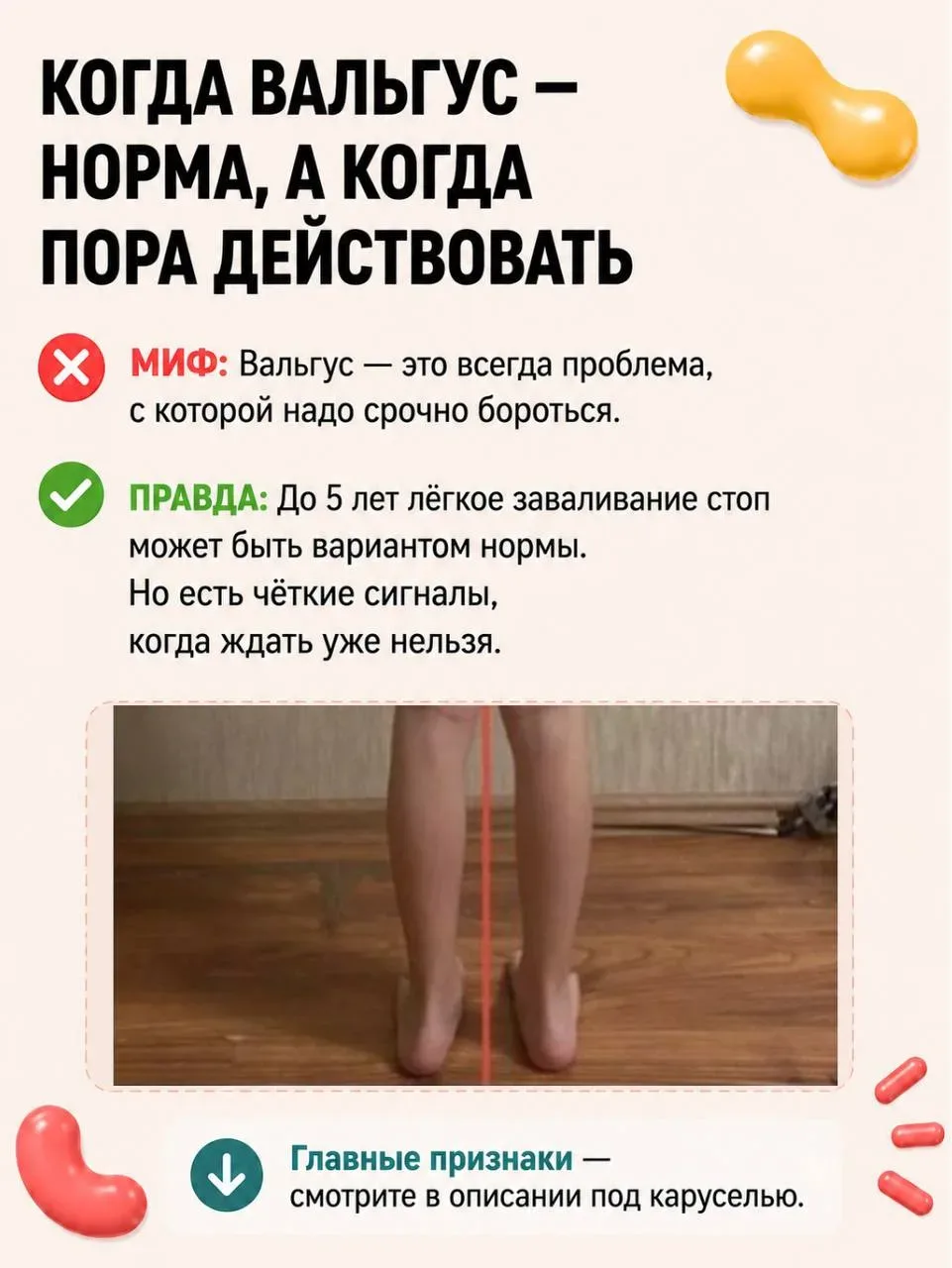 Вальгус исправляется. Но только если вы не совершаете эти ошибки.  Большинство родителей годами ждут