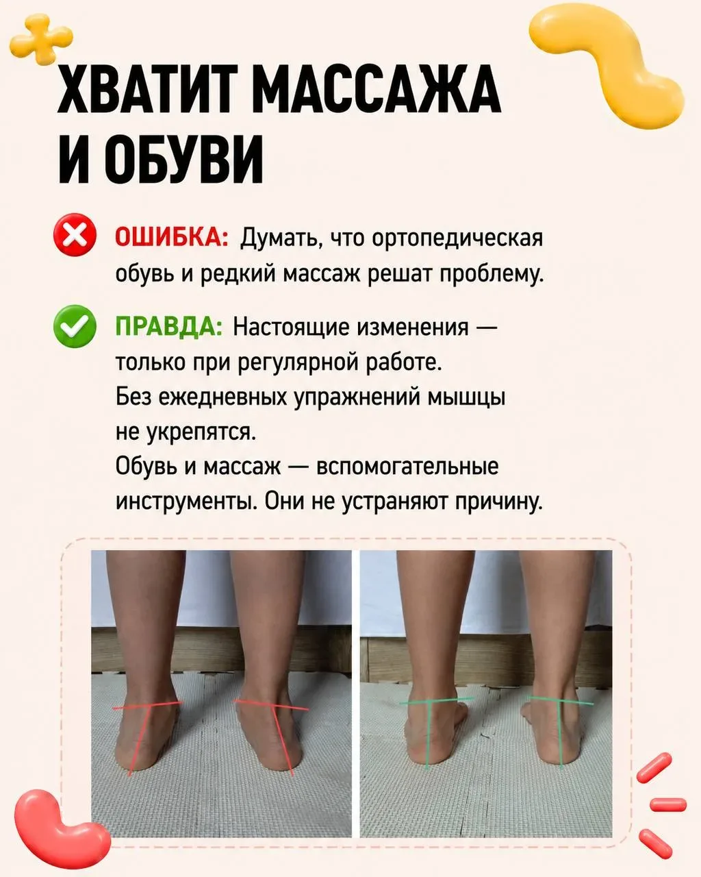 Вальгус исправляется. Но только если вы не совершаете эти ошибки.  Большинство родителей годами ждут