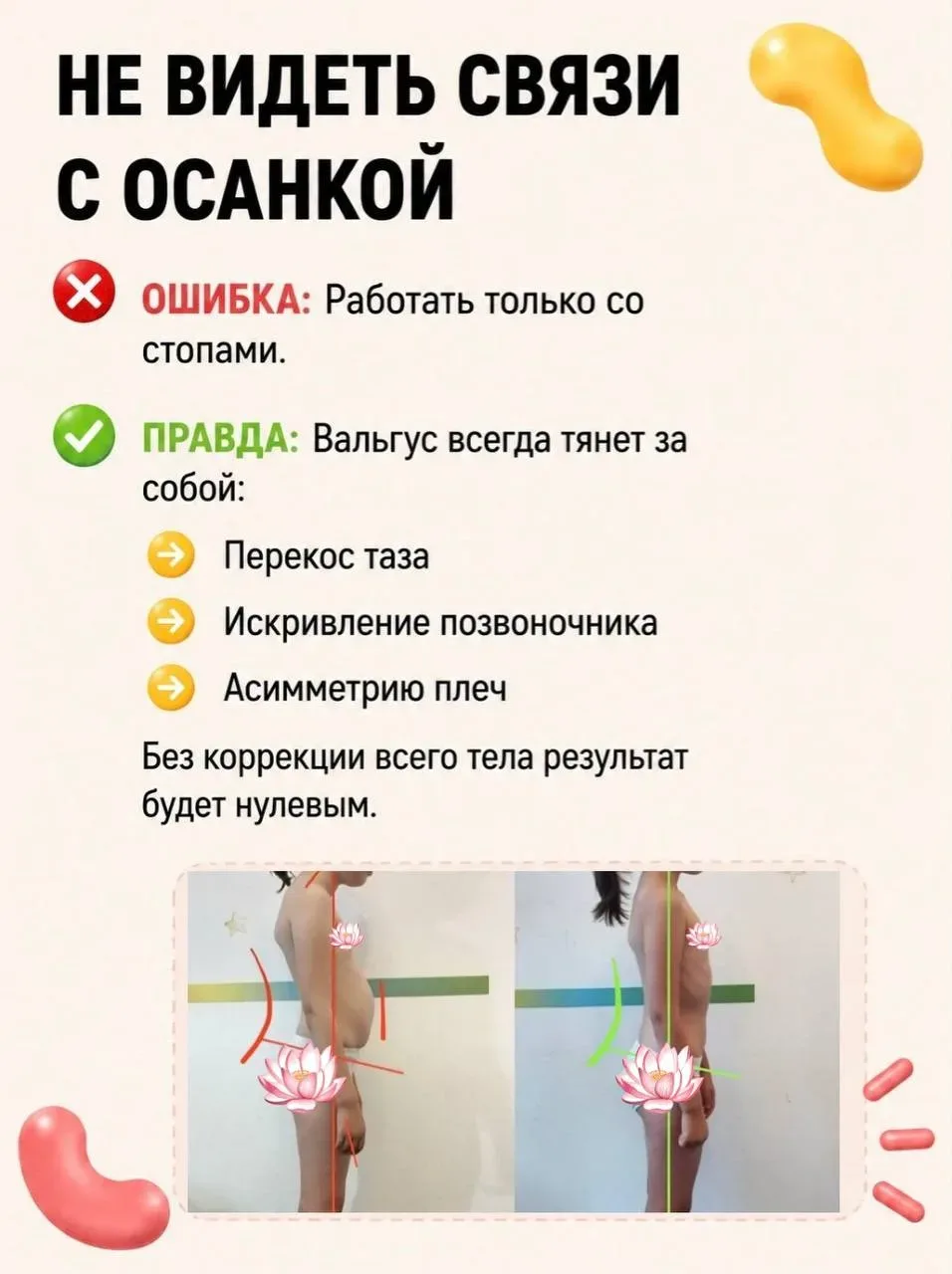 Вальгус исправляется. Но только если вы не совершаете эти ошибки.  Большинство родителей годами ждут