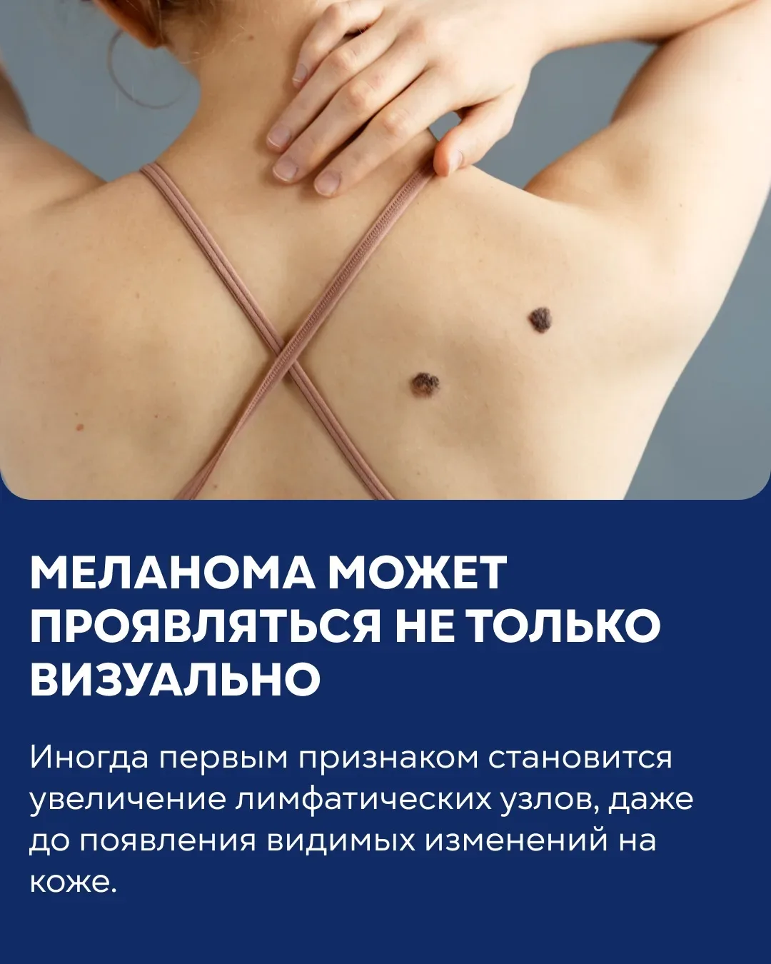 ⚡️11 мая — Всемирный день борьбы с меланомой. Интервью с заместителем главного врача  по онкологии к
