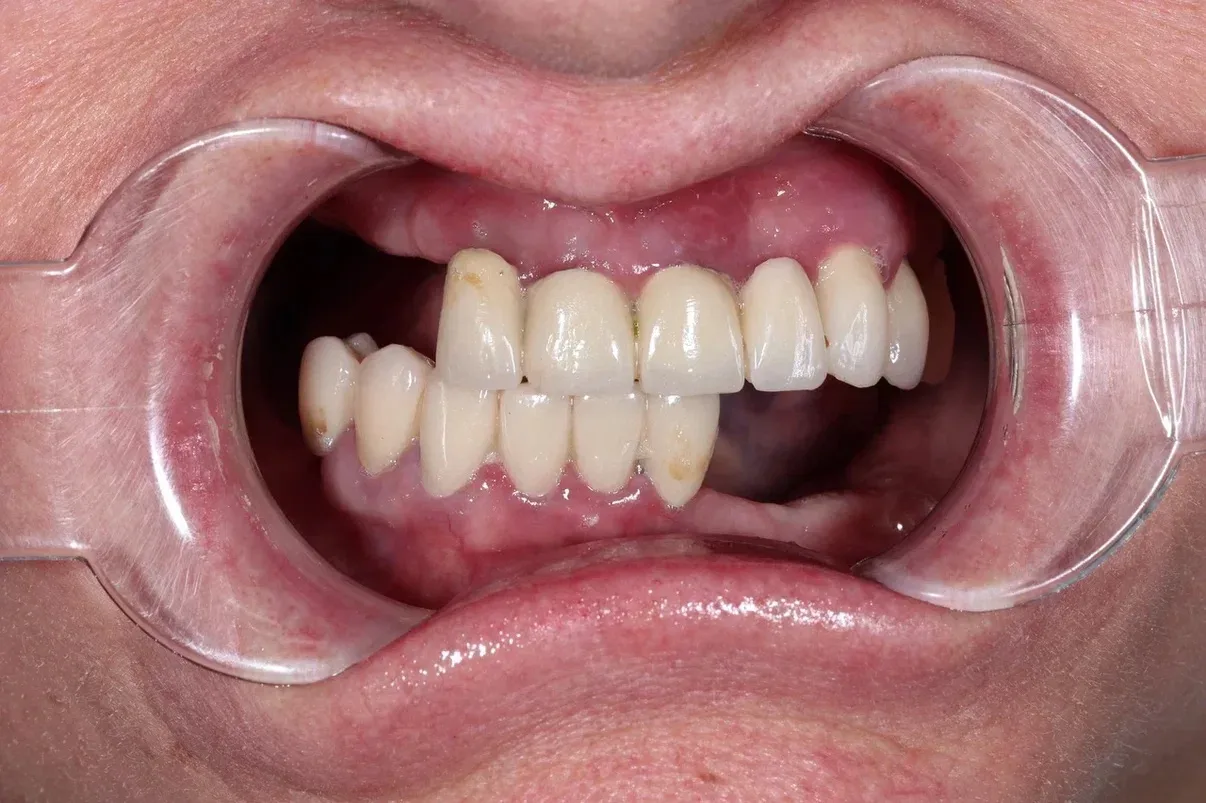🦷ДО/ПОСЛЕ. ВСЕ ЗУБЫ — за 3 дня и сразу с постоянной конструкцией  Светлана Алексеевна долгие года жи