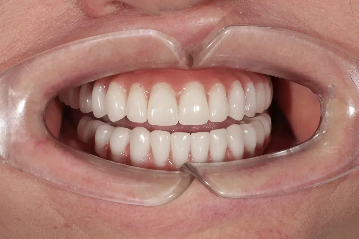 🦷ДО/ПОСЛЕ. ВСЕ ЗУБЫ — за 3 дня и сразу с постоянной конструкцией  Светлана Алексеевна долгие года жи