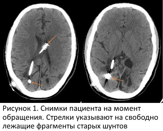 В НМИЦ нейрохирургии им. акад. Н.Н. Бурденко спасли пациента, перенесшего 48 операций на мозге.  🏨 В