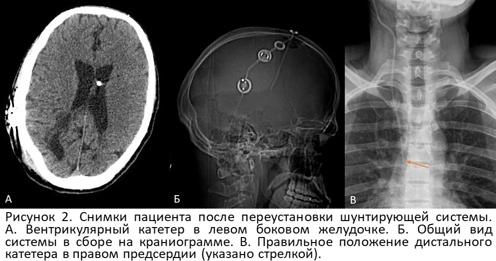 В НМИЦ нейрохирургии им. акад. Н.Н. Бурденко спасли пациента, перенесшего 48 операций на мозге.  🏨 В