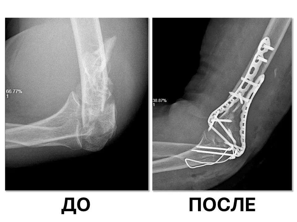 В Королёвской больнице врачи восстановили сустав после тяжёлой травмы  В Королёвскую городскую больн