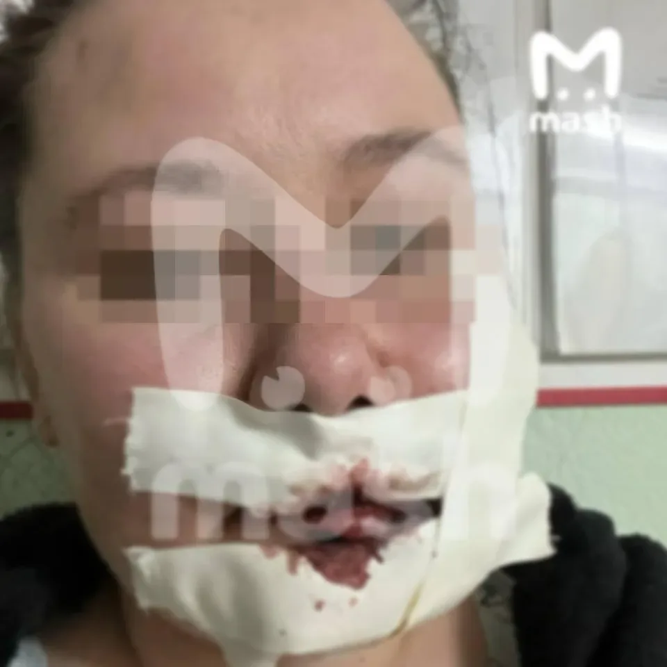 🤕 Жительнице Уфы выплатили 250 рублей компенсации за шрам на пол-лица после ДТП  В октябре 2025 года