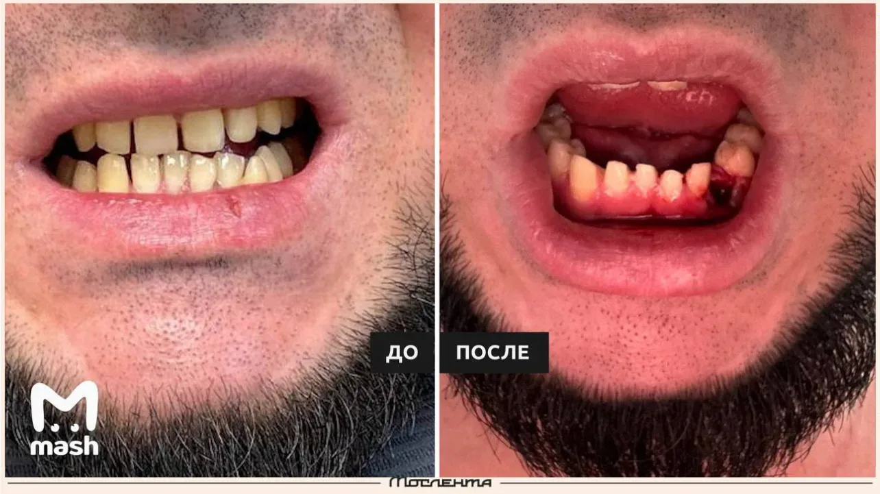 🦷 Москвич потерял 500 тысяч рублей, набрал 20 кг и впал в депрессию из-за плохо сделанных виниров.  