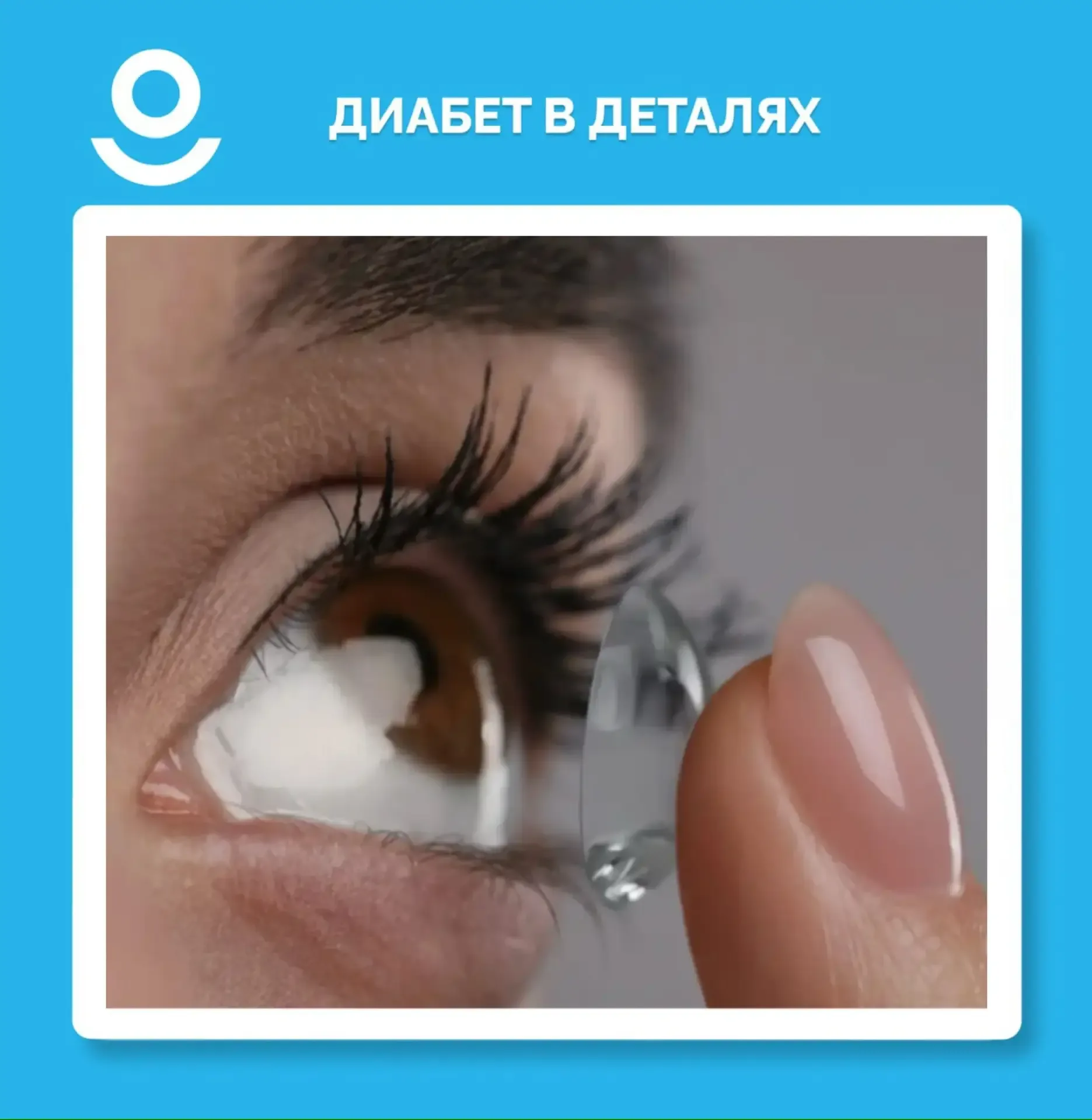 МОЖНО ЛИ ИСПОЛЬЗОВАТЬ НОЧНЫЕ ЛИНЗЫ ПРИ САХАРНОМ ДИАБЕТЕ?  📍Можно, но не всем – и только после осмотр