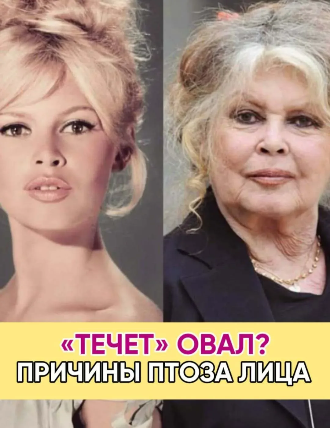 😱 Думали, просто устали? Ваше лицо ОПУСКАЕТСЯ!   ДЕФОРМАЦИОННО-ПТОЗНЫЙ ТИП СТАРЕНИЯ – УДАР ПО ПЛОТНО